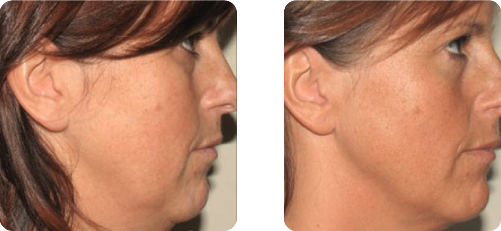 Joues et visage Joues et visage