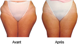 Exemples de réduction de la cellulite avant et après traitement avec Med Sculpt Exemples de réduction de la cellulite avant et après traitement avec Med Sculpt