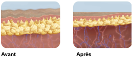 Action sur la cellulite avant et après Action sur la cellulite avant et après