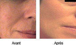 Résultats sur le visage Résultats sur le visage